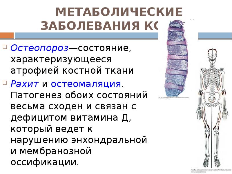 МЕТАБОЛИЧЕСКИЕ ЗАБОЛЕВАНИЯ КОСТЕЙ Остеопороз—состояние, характеризующееся атрофией костной ткани  Рахит и