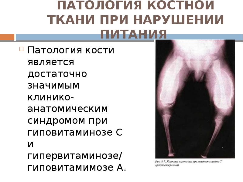 ПАТОЛОГИЯ КОСТНОЙ ТКАНИ ПРИ НАРУШЕНИИ ПИТАНИЯ   Патология кости является