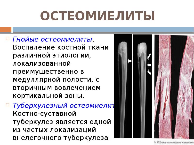 ОСТЕОМИЕЛИТЫ  Гнойые остеомиелиты. Воспаление костной ткани различной этиологии, локализованной преимущественно