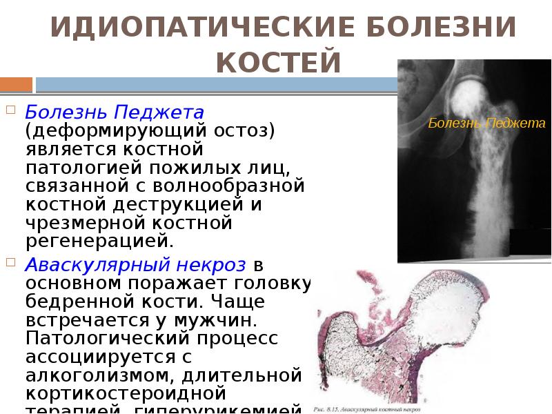 ИДИОПАТИЧЕСКИЕ БОЛЕЗНИ КОСТЕЙ  Болезнь Педжета (деформирующий остоз) является костной патологией
