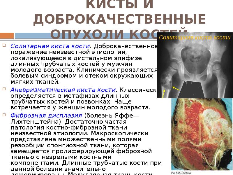 КИСТЫ И ДОБРОКАЧЕСТВЕННЫЕ ОПУХОЛИ КОСТЕЙ Солитарная киста кости. Доброкачественное поражение неизвестной