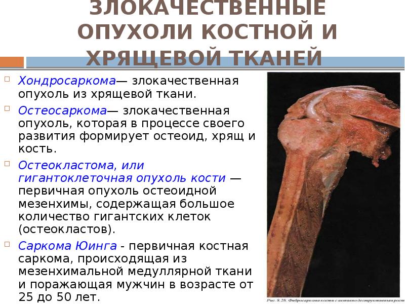 ЗЛОКАЧЕСТВЕННЫЕ ОПУХОЛИ КОСТНОЙ И ХРЯЩЕВОЙ ТКАНЕЙ  Хондросаркома— злокачественная опухоль из