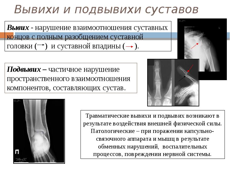 Вывихи и подвывихи суставов