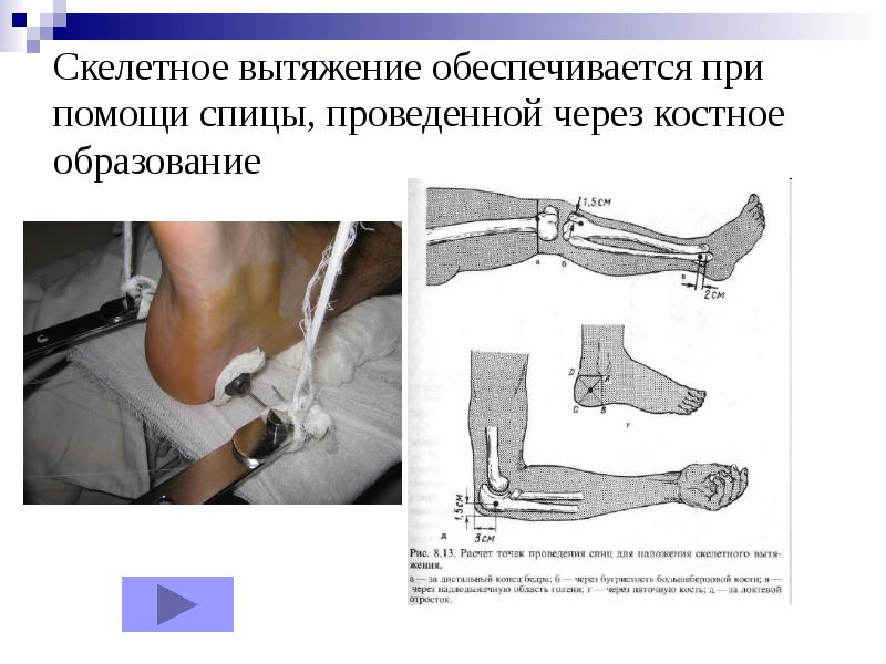 Перелом нижней трети голени карта вызова скорой медицинской