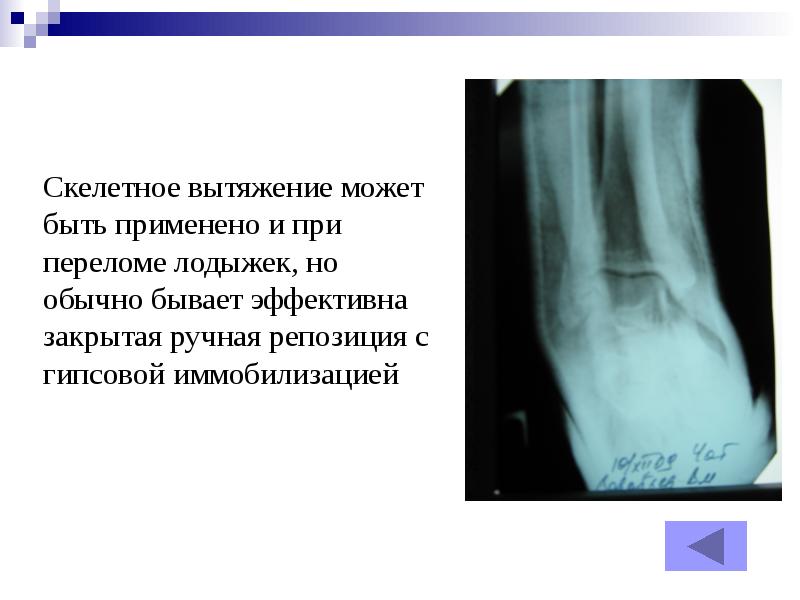 Переломы голеностопа презентация