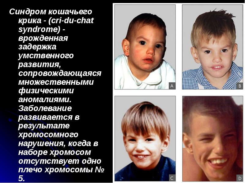 Синдром кошачьего крика - (cri-du-chat syndrome) - врожденная задержка умственного развития, Синдром кошачьего крика - (cri-du-chat syndrome) - врожденная задержка умственного развития,