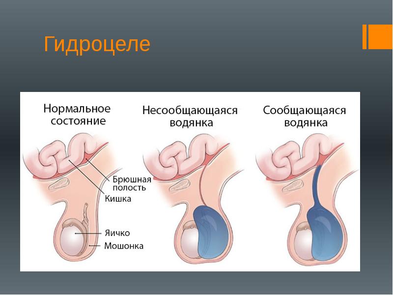 Водянка яичка у детей презентация