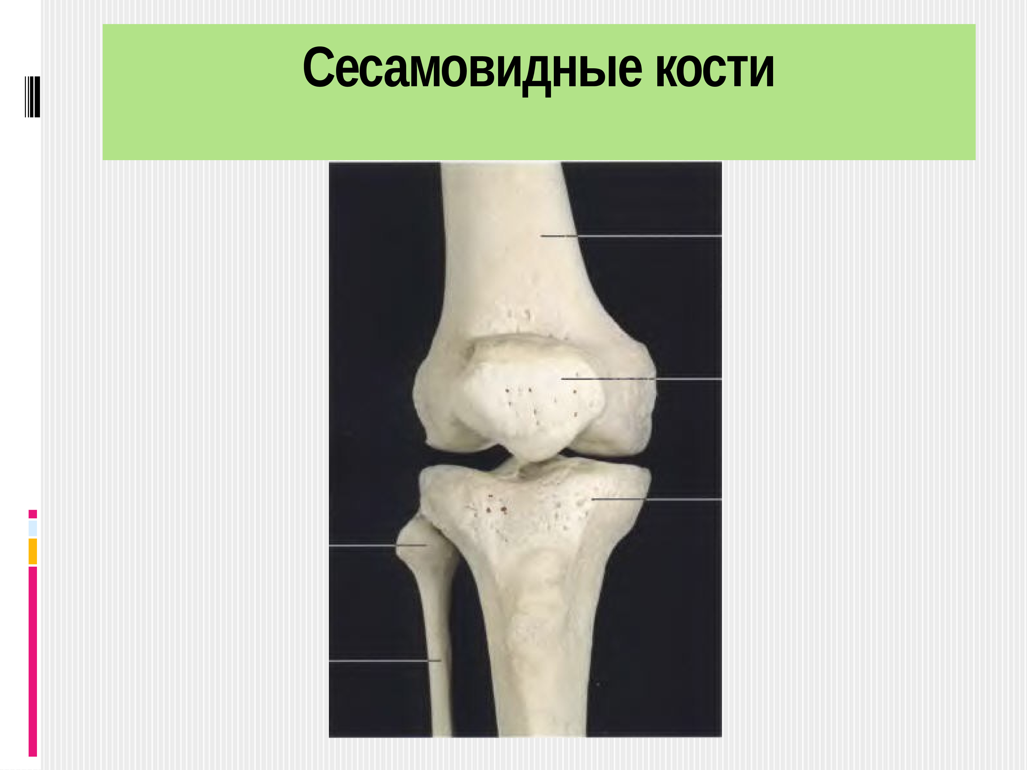 Сесамовидные кости. Губчатая сесамовидная кость. Сесамовидная кость коленного сустава рентген. Сесамовидная кость 1 плюснефалангового сустава.