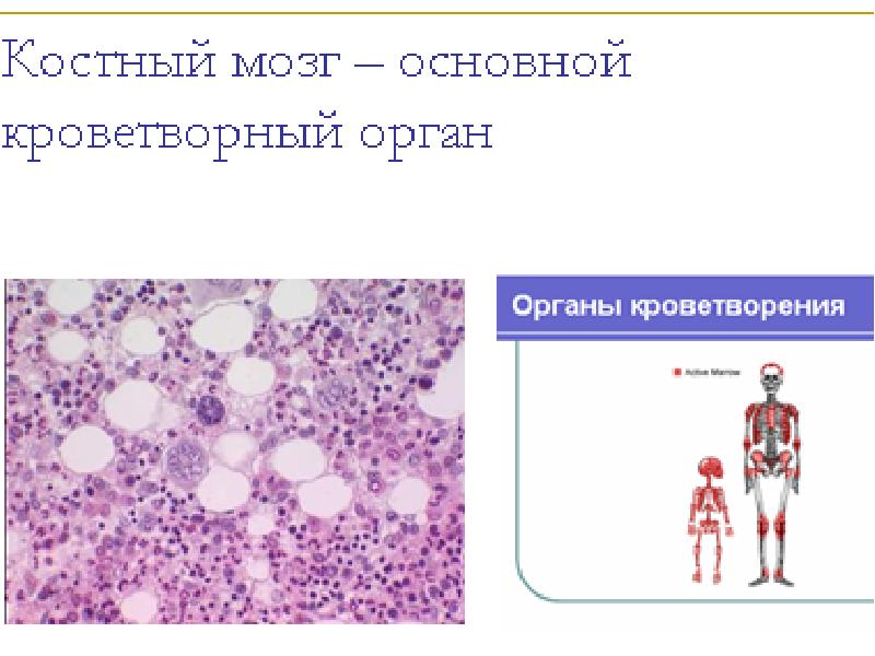 Гемобластозы патологическая анатомия презентация