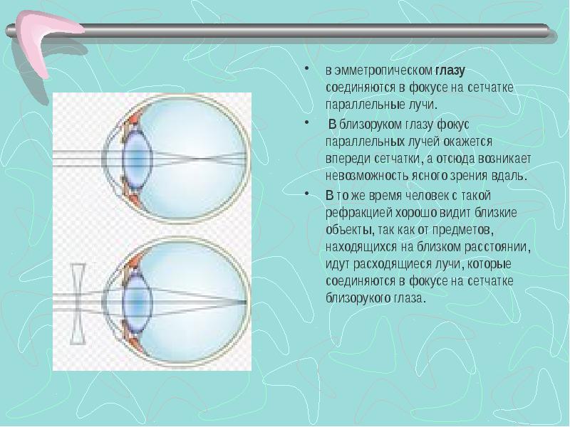 Состояние покоя аккомодации фокус на сетчатке рисунок