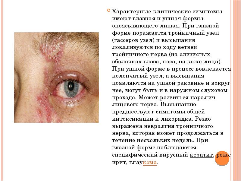 Характерные клинические симптомы имеют глазная и ушная формы опоясывающего лишая. При Характерные клинические симптомы имеют глазная и ушная формы опоясывающего лишая. При