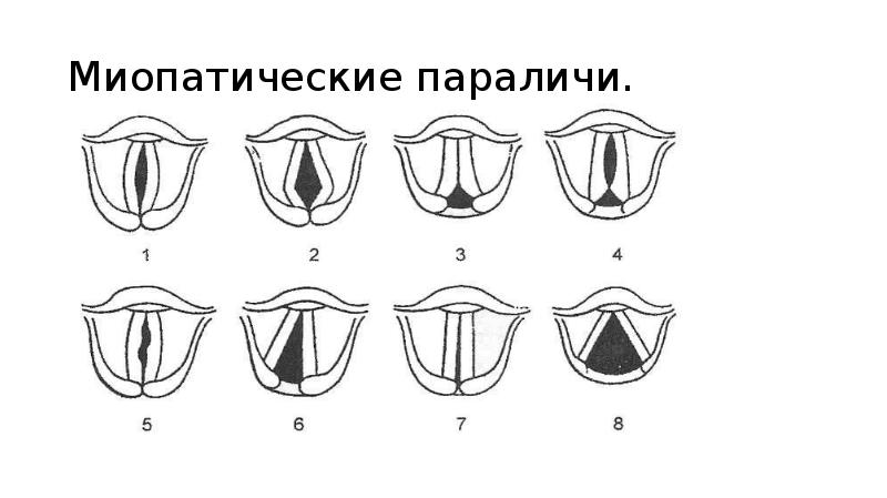 Парезы и параличи гортани презентация