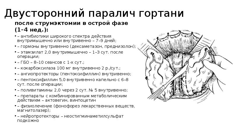 Двусторонний паралич