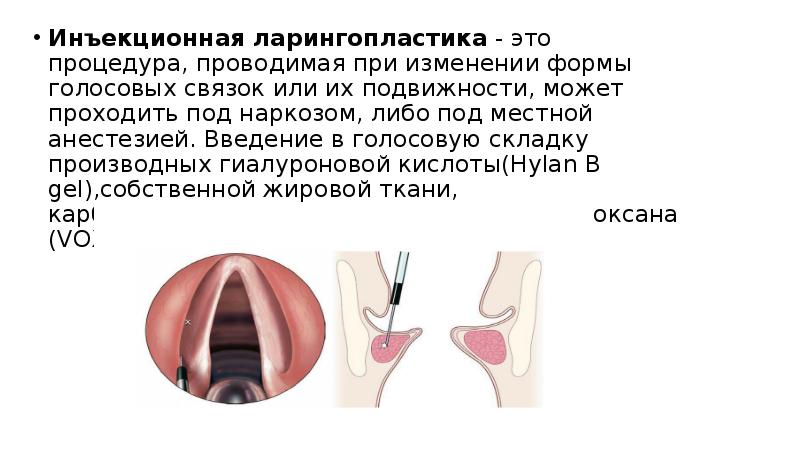 Парезы и параличи гортани презентация