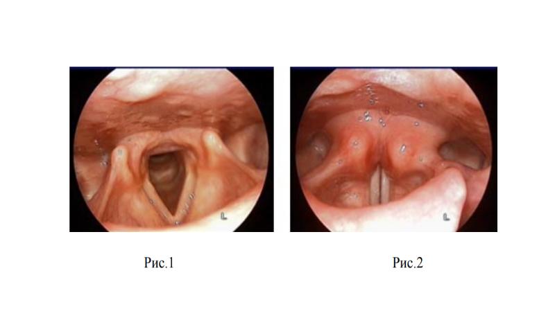 Парезы и параличи гортани презентация