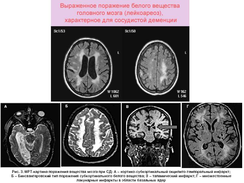 Презентация сосудистая деменция