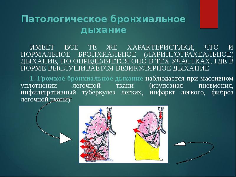 Какая аускультативная картина характерна для сухого плеврита