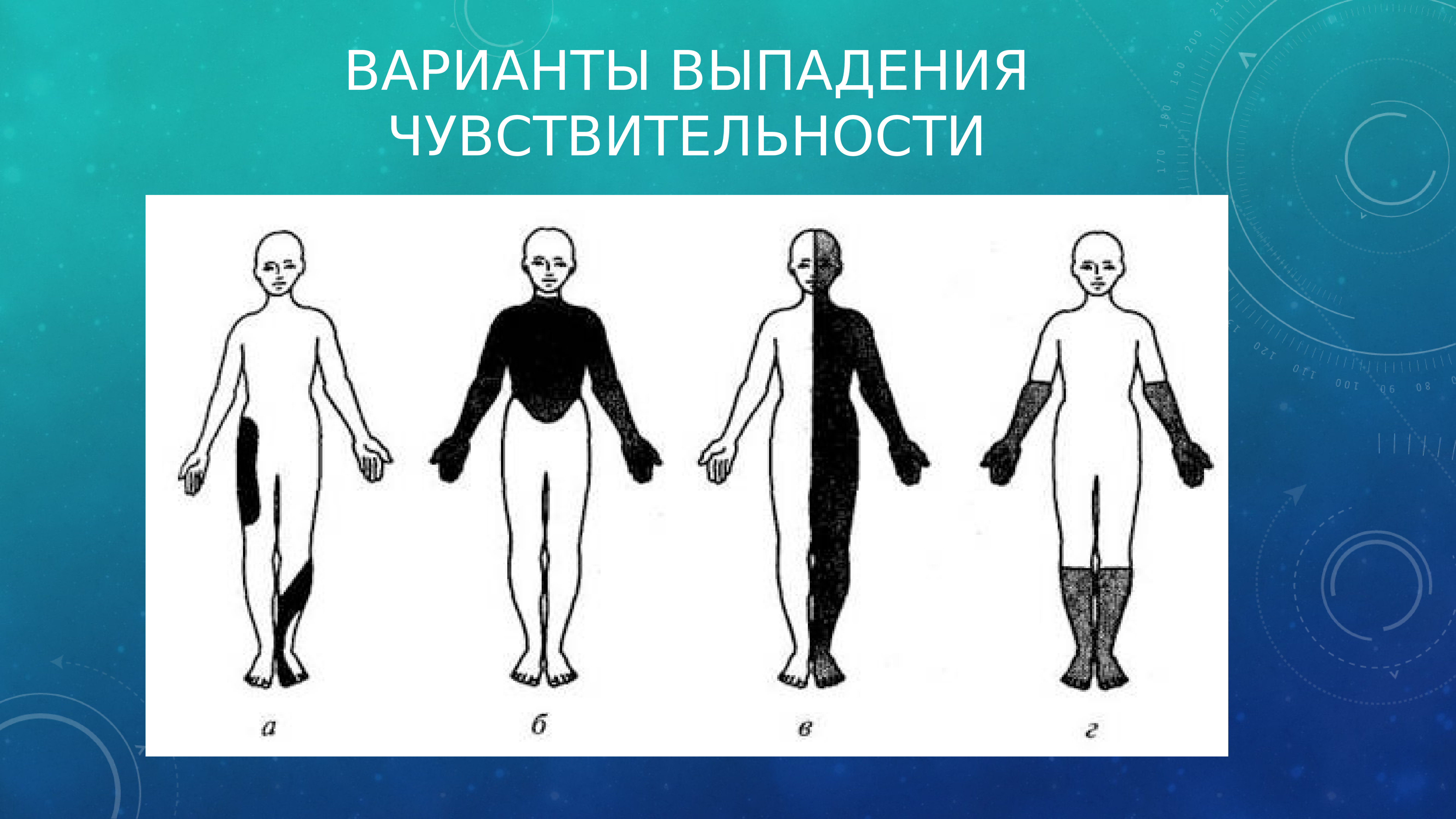 Полиневритический тип расстройства. Типы выпадения чувствительности. Типы нарушения чувствительности. Нарушение чувствительности по полиневритическому типу. Мозаичные выпадения чувствительности.