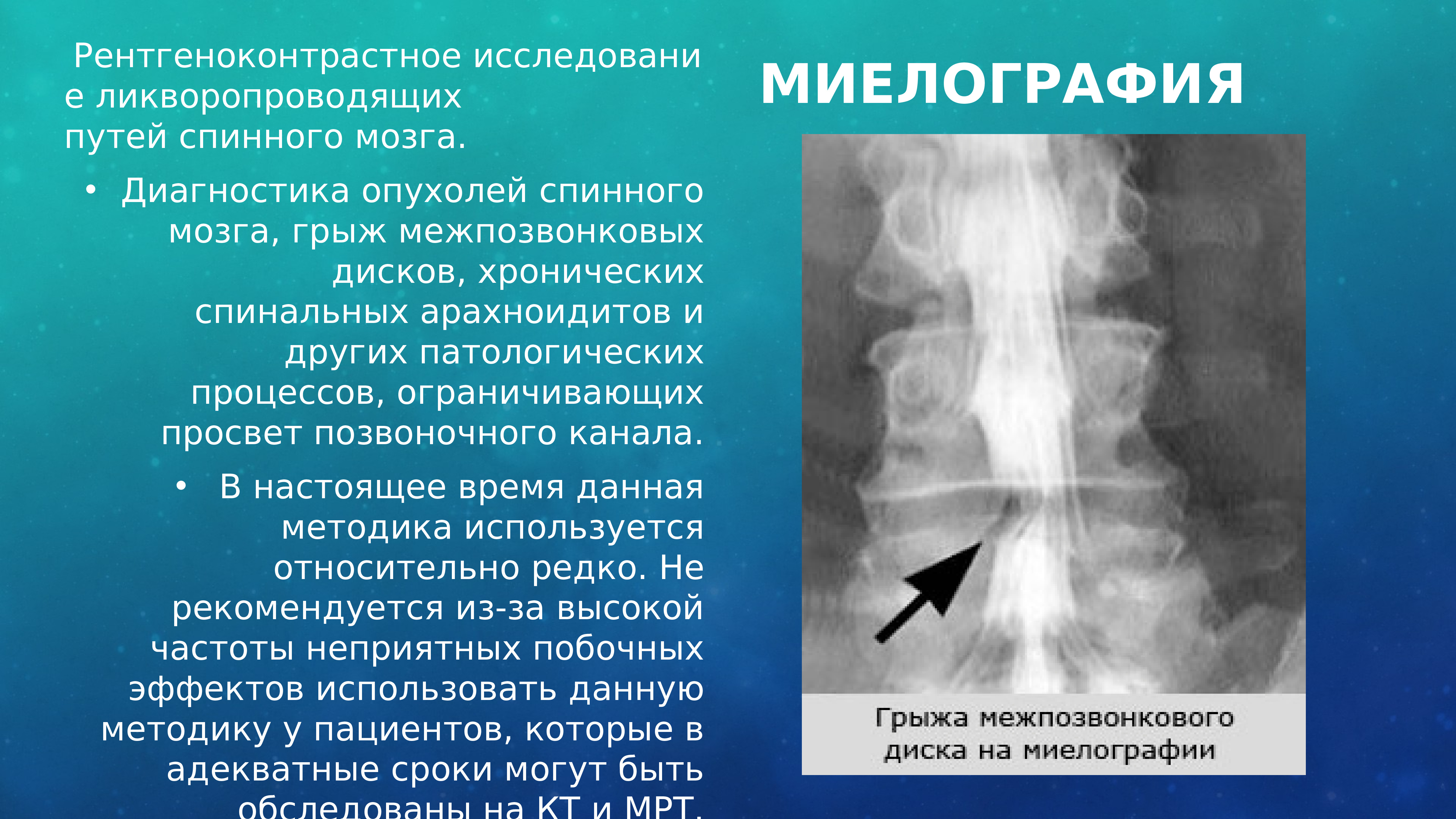 Контрастная миелография