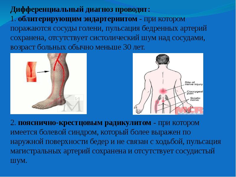 Проведи диагноз. Облитерирующий эндартериит диф диагноз. Облитерирующий эндартериит диагностика. При облитерирующем эндартериите поражаются. Диф диагностика облитерирующего эндартериита.