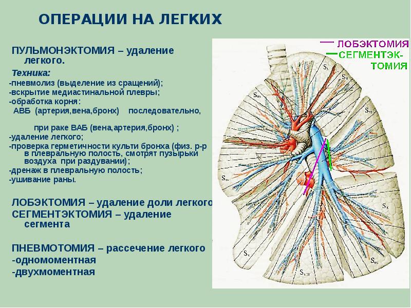 Операции на легких презентация