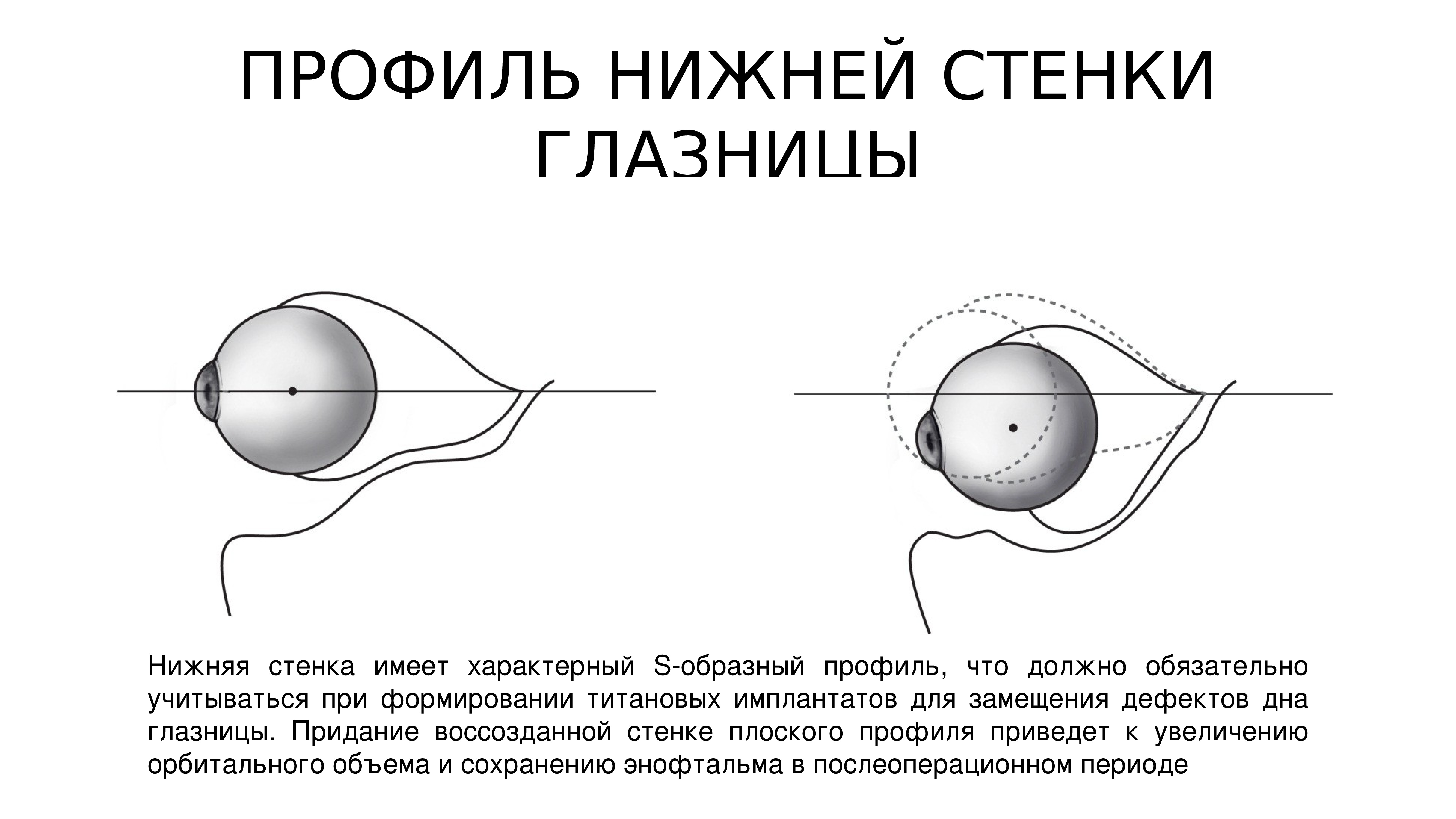 Самая тонкая стенка глазницы