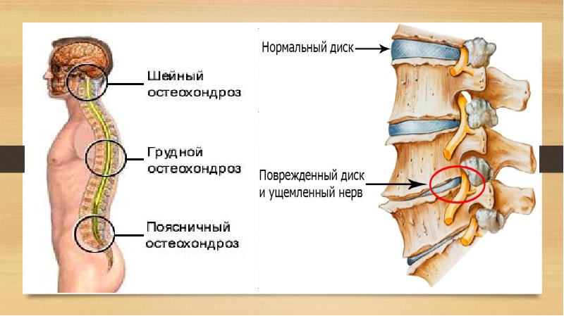 Остеохондроз шейный нерв