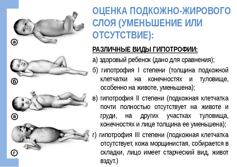 Белково энергетическая недостаточность у детей презентация