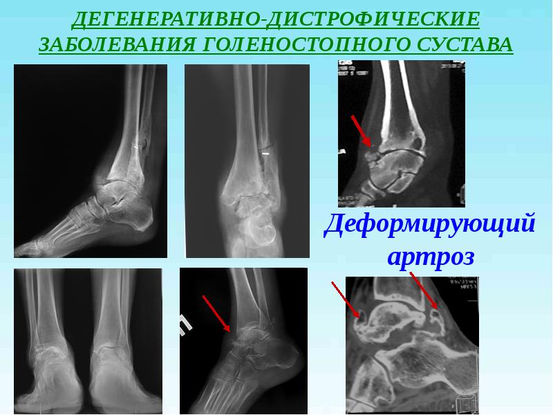 Артроз голеностопного сустава 2 степени схема лечения