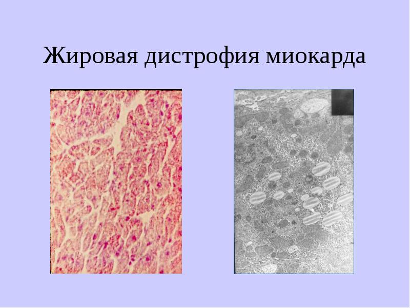 Жировая дистрофия миокарда. Паренхиматозная жировая дистрофия миокарда. Гидропическая дистрофия миокарда. Гидропическая дистрофия миокарда микропрепарат. Жировая инфильтрация миокарда.