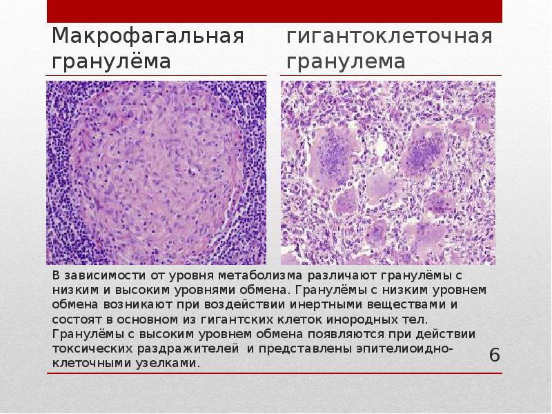 Гранулематозное воспаление презентация