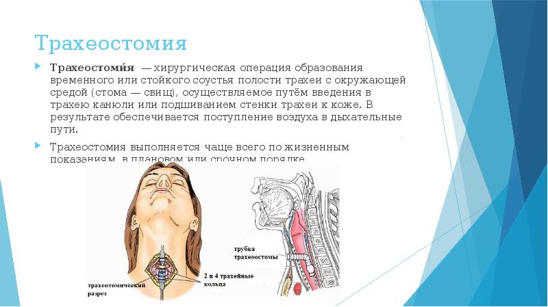 Уход за трахеостомой презентация