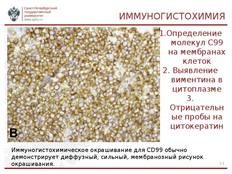 Саркома юинга презентация