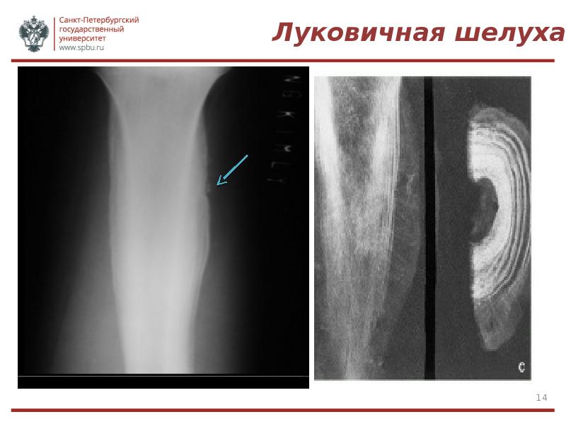 Саркома юинга презентация