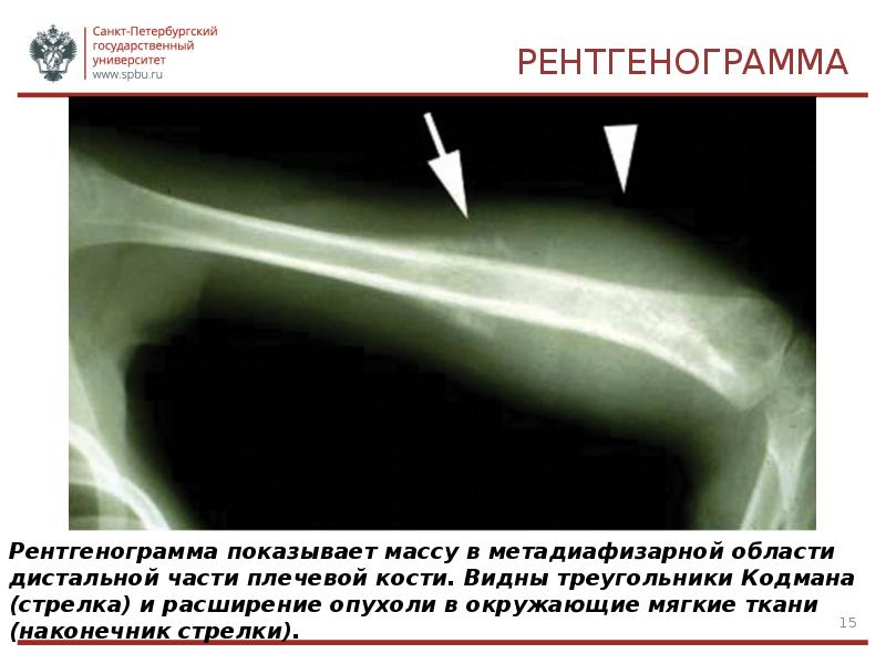 Саркома юинга презентация