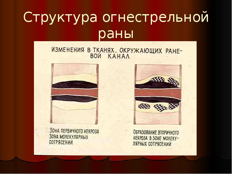 Огнестрельная рана пулевая. Обработка огнестрельной раны. Обработка огнестрельных ран. Принципы лечения огнестрельных ран. Принципы хирургической обработки огнестрельных ран.