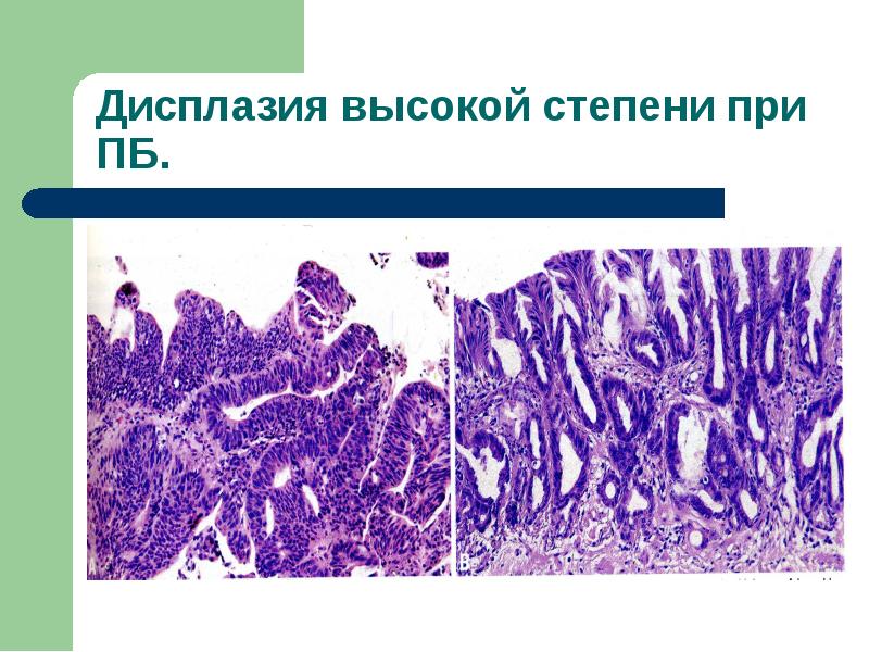 Интраэпителиальная неоплазия толстой кишки. Интраэпителиальная неоплазия желудка. Интраэпителиальная неоплазия высокой степени толстой кишки. Нитраэпитальная ниоплазия желудка. Дисплазия высокой степени.