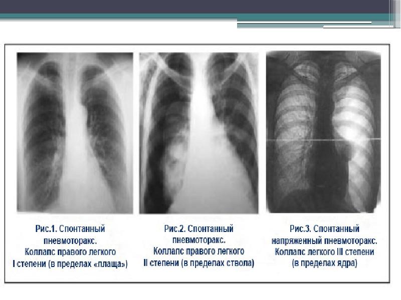 Презентация пневмоторакс и гемоторакс