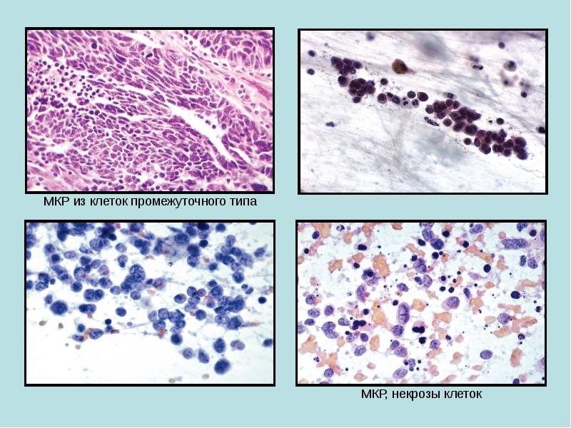Цитологическая картина фкб - 98 фото