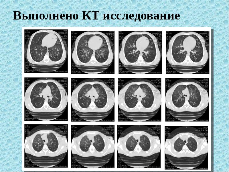 Муковисцидоз рентгенологическая картина