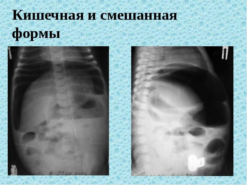 Муковисцидоз рентгенологическая картина