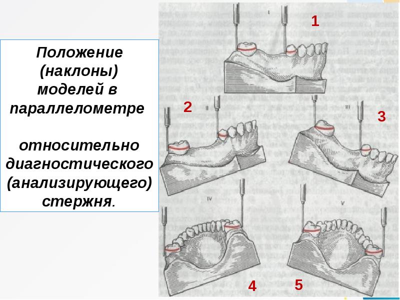 Презентация на тему параллелометрия