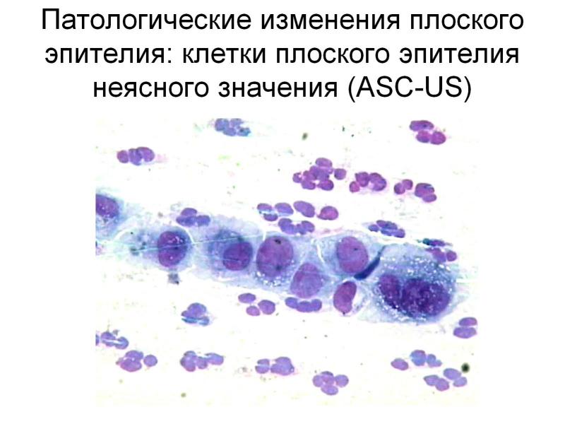 Атипия неясного значения asc us. Атипичные клетки плоского эпителия неопределенного значения. Атипия клеток плоского эпителия. Дискариоз клеток плоского эпителия шейки. Реактивные изменения клеток плоского эпителия.