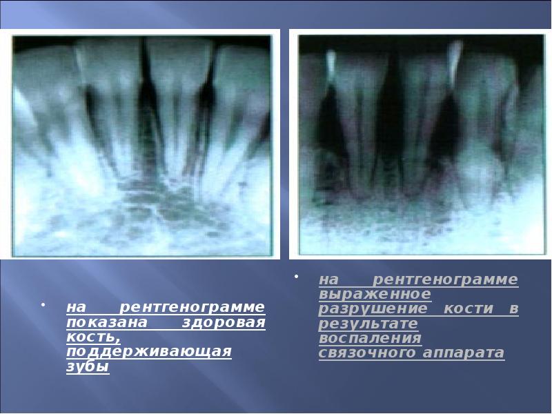 Рентгенологическая картина здорового пародонта