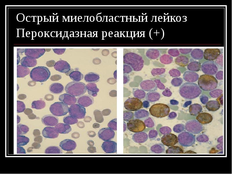 Опухоли кроветворной системы презентация