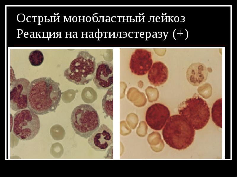 Эритромиелоз картина крови