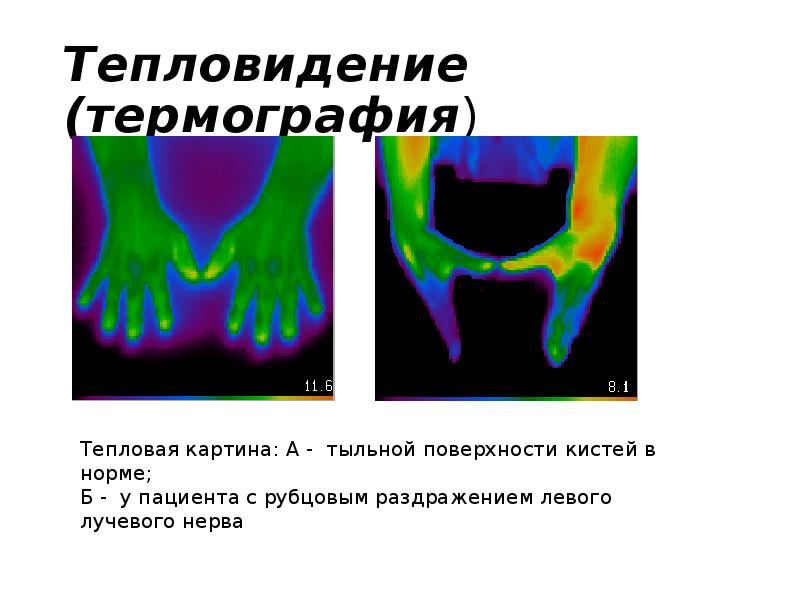 Термография. Тепловидение. Термография кисти. Контактная термография. Термография в медицине презентация.