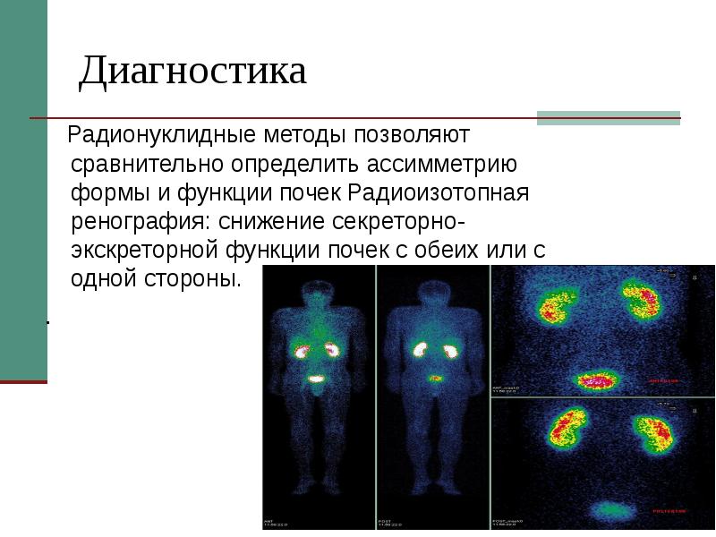 Радионуклидная диагностика. Радионуклидный метод пиелонефрит. Радионуклеидные методы. Радионуклидная диагностика методы. Радиоизотопная диагностика.