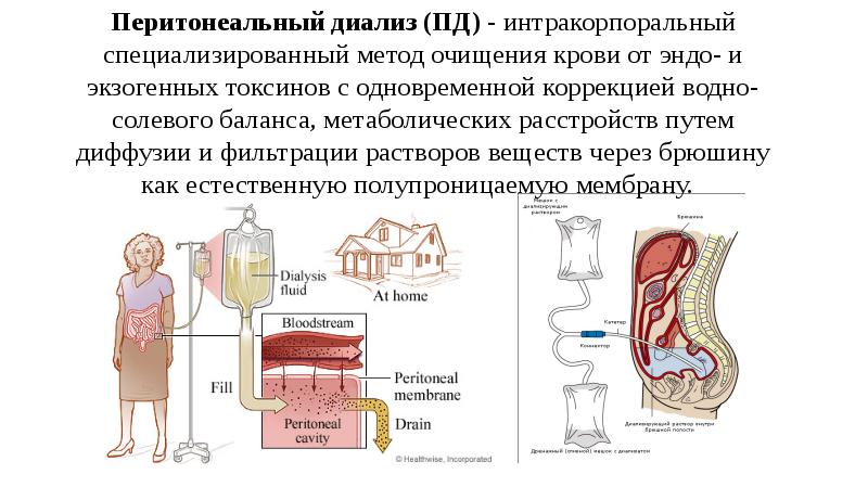 Перитонеальный диализ что это