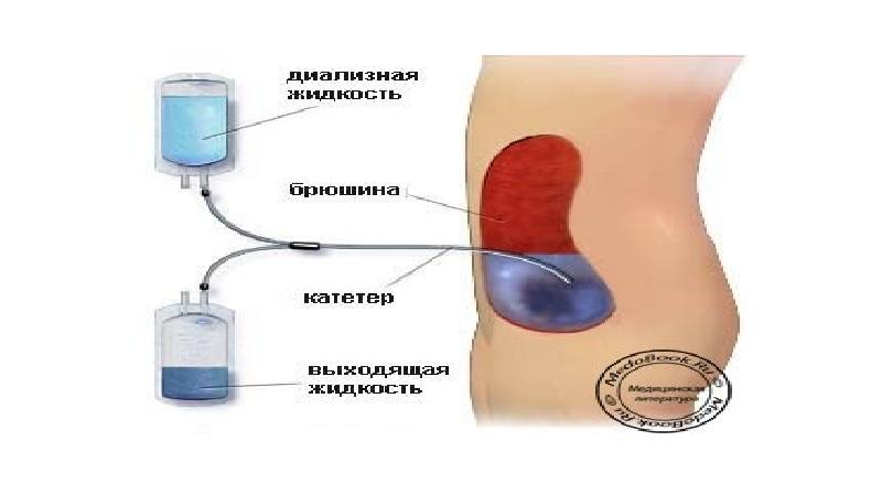 Перитонеальный диализ презентация
